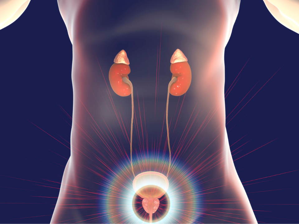 litotrissia laser